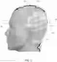 Fig. 06 - Delivering tumor treating fields (TTFields) to the infratentorial brain
