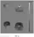 Fig. 07 - Delivering tumor treating fields (TTFields) to the infratentorial brain