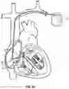 Fig. 03 - SYSTEMS, DEVICES, AND METHODS FOR HIS BUNDLE CARDIAC PACING