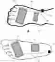 Fig. 01 - Peripheral neuromodulation to treat bladder and bowel dysfunction