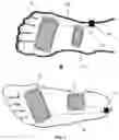 Fig. 03 - Peripheral neuromodulation to treat bladder and bowel dysfunction