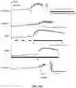 Fig. 19 - Peripheral neuromodulation to treat bladder and bowel dysfunction