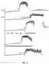 Fig. 27 - Peripheral neuromodulation to treat bladder and bowel dysfunction