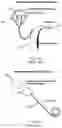 Fig. 10 - Implantable battery device for standard cochlear implant