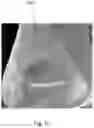 Fig. 12 - Phototherapy devices and methods for treating truncal acne and scars