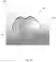 Fig. 15 - Phototherapy devices and methods for treating truncal acne and scars