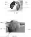 Fig. 16 - Phototherapy devices and methods for treating truncal acne and scars