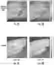 Fig. 03 - Systems for detecting vascular and arterial disease in asymptomatic patients and related methods