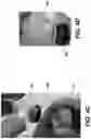 Fig. 06 - Cytology cell block preparation devices and methods of cell block prepartaion using same