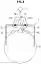 Fig. 04 - SURGICAL LOUPE