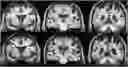 Fig. 01 - Systems and methods for the identification of perivascular spaces in magnetic resonance imaging (MRI)