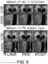 Fig. 16 - Systems and methods for the identification of perivascular spaces in magnetic resonance imaging (MRI)