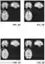Fig. 03 - Image registration using a fully convolutional network