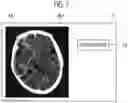 Fig. 06 - Apparatus, method, and program for learning discriminator discriminating infarction region, discriminator for discriminating infarction region, and apparatus, method, and program for discriminating infarction region