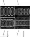 Fig. 05 - CONTACTLESS AIR-FILLED SUBSTRATE INTEGRATED WAVEGUIDE DEVICES AND METHODS