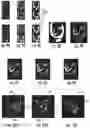 Fig. 11 - Rapid quantitative evaluations of heart function with strain measurements from strain encoded MRI