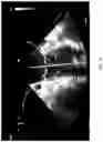 Fig. 18 - Apparatus and methods for alignment and deployment of intracardiac devices