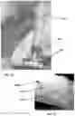 Fig. 05 - Method for obtaining sterile human amniotic fluid and uses thereof
