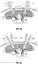 Fig. 19 - Minimally open interbody access retraction device and surgical method