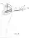 Fig. 13 - Suture anchor and method