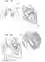 Fig. 02 - Helical anchor implantation