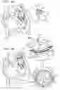 Fig. 10 - Helical anchor implantation