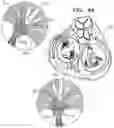 Fig. 12 - Helical anchor implantation