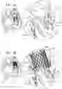 Fig. 14 - Helical anchor implantation