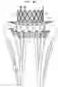 Fig. 17 - Helical anchor implantation