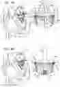 Fig. 21 - Helical anchor implantation