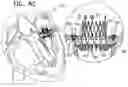 Fig. 22 - Helical anchor implantation