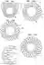 Fig. 32 - Helical anchor implantation