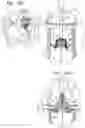 Fig. 34 - Helical anchor implantation