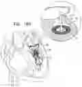 Fig. 38 - Helical anchor implantation