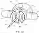Fig. 08 - Flexible anchor delivery system