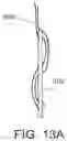 Fig. 21 - Flexible anchor delivery system