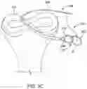 Fig. 16 - Self-cinching suture construct apparatus