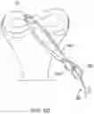 Fig. 17 - Self-cinching suture construct apparatus