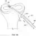 Fig. 18 - Self-cinching suture construct apparatus