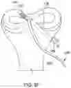 Fig. 19 - Self-cinching suture construct apparatus