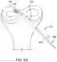 Fig. 20 - Self-cinching suture construct apparatus