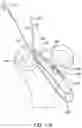 Fig. 35 - Self-cinching suture construct apparatus