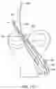 Fig. 36 - Self-cinching suture construct apparatus