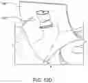 Fig. 43 - Self-cinching suture construct apparatus