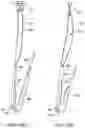 Fig. 51 - Self-cinching suture construct apparatus