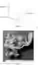 Fig. 02 - Abdominal closure method and device for ventral hernia