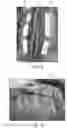 Fig. 04 - Abdominal closure method and device for ventral hernia