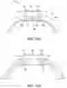 Fig. 07 - Abdominal closure method and device for ventral hernia