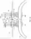 Fig. 13 - Abdominal closure method and device for ventral hernia