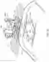 Fig. 14 - Abdominal closure method and device for ventral hernia